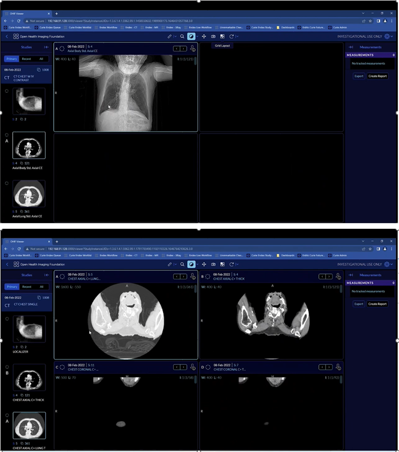 Subpleural View