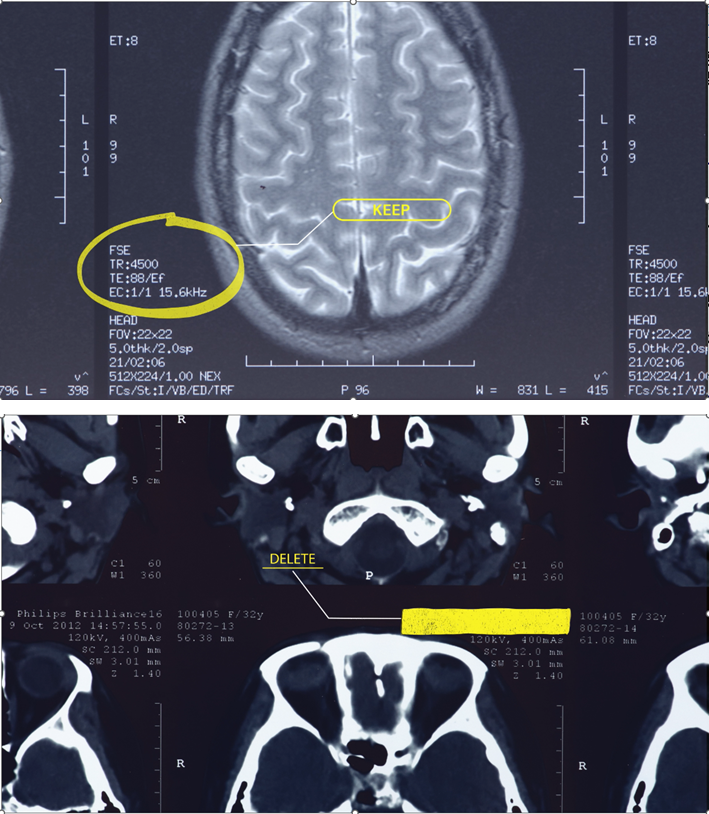 Tracheal Analysis